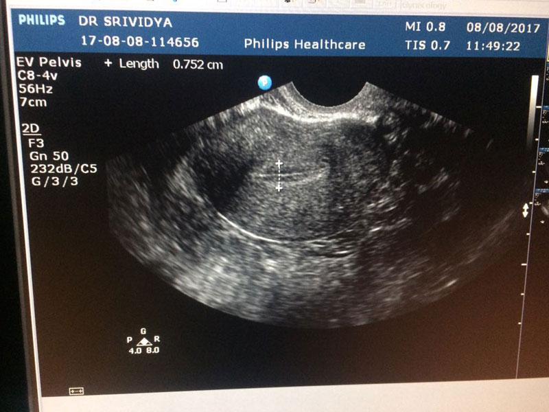 Intrauterine insemination in Andhra Pradesh,iui treatments in Andhra Pradesh,Intrauterine insemination treatments in Andhra Pradesh,Best Fertility Hospital In Andhra Pradesh,Best IVF Doctors In Andhra Pradesh,Best IVF centers In Andhra Pradesh,In Vitro Fertilization treatments in Andhra Pradesh,ivf treatments in Andhra Pradesh,ivf treatment in Andhra Pradesh,fertilization hospitals in Andhra Pradesh,In Vitro Fertilization, IVF Treatment in Andhra Pradesh,Best Infertility centers in Andhra Pradesh,Best Center for Human Reproduction,IVF and Reproductive Medicine,Fertility and Reproductive Medicine,ICSI and IVF for Male Infertility hospitals in Andhra Pradesh,Intracytoplasmic sperm injection treatments in Andhra Pradesh,ICSI Infertility Treatment in Andhra Pradesh,ICSI Treatment centers in Andhra Pradesh,gynaecology hospitals in Andhra Pradesh,gynaecology specialists in Andhra Pradesh,best gynaecology hospitals in Andhra Pradesh,obstetrics and gynaecology hospitals in Andhra Pradesh,Best obstetrics and gynaecology doctors in Andhra Pradesh,Vaginal Infections specialist in Andhra Pradesh,Pelvic Masses or Pelvic Tumor Treatment in Andhra Pradesh,gynaecology treatments in Andhra Pradesh,gynaecologist doctors in Andhra Pradesh,best Gynaecologist in Andhra Pradesh,Uterine Bleeding treatments in Andhra Pradesh,Best obstetric specialist in Andhra Pradesh,High pregnancy risk specialists in Andhra Pradesh,Polycystic Ovarian Disease treatments in Andhra Pradesh,Prenatal and Antepartum Care in Andhra Pradesh,Best Gynaecology Cesarean in Andhra Pradesh,Care for Pregnancy on Diabetes in Andhra Pradesh,Hypertension, pre-eclampsia and eclampsia treatments in Andhra Pradesh,Premature Rupture treatments in Andhra Pradesh,Post-term pregnancy care in Andhra Pradesh