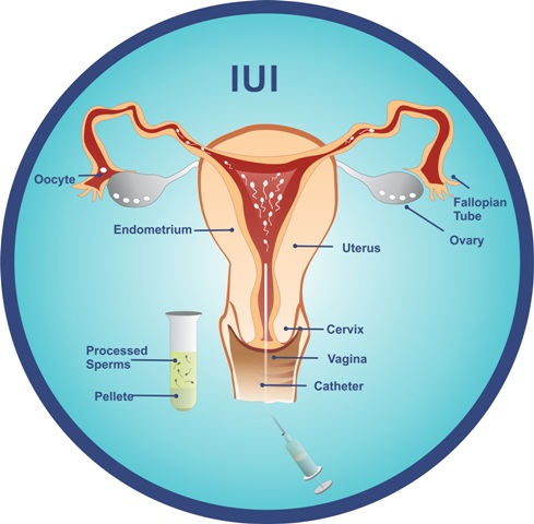 Intrauterine insemination in Andhra Pradesh,iui treatments in Andhra Pradesh,Intrauterine insemination treatments in Andhra Pradesh,Best Fertility Hospital In Andhra Pradesh,Best IVF Doctors In Andhra Pradesh,Best IVF centers In Andhra Pradesh,In Vitro Fertilization treatments in Andhra Pradesh,ivf treatments in Andhra Pradesh,ivf treatment in Andhra Pradesh,fertilization hospitals in Andhra Pradesh,In Vitro Fertilization, IVF Treatment in Andhra Pradesh,Best Infertility centers in Andhra Pradesh,Best Center for Human Reproduction,IVF and Reproductive Medicine,Fertility and Reproductive Medicine,ICSI and IVF for Male Infertility hospitals in Andhra Pradesh,Intracytoplasmic sperm injection treatments in Andhra Pradesh,ICSI Infertility Treatment in Andhra Pradesh,ICSI Treatment centers in Andhra Pradesh,gynaecology hospitals in Andhra Pradesh,gynaecology specialists in Andhra Pradesh,best gynaecology hospitals in Andhra Pradesh,obstetrics and gynaecology hospitals in Andhra Pradesh,Best obstetrics and gynaecology doctors in Andhra Pradesh,Vaginal Infections specialist in Andhra Pradesh,Pelvic Masses or Pelvic Tumor Treatment in Andhra Pradesh,gynaecology treatments in Andhra Pradesh,gynaecologist doctors in Andhra Pradesh,best Gynaecologist in Andhra Pradesh,Uterine Bleeding treatments in Andhra Pradesh,Best obstetric specialist in Andhra Pradesh,High pregnancy risk specialists in Andhra Pradesh,Polycystic Ovarian Disease treatments in Andhra Pradesh,Prenatal and Antepartum Care in Andhra Pradesh,Best Gynaecology Cesarean in Andhra Pradesh,Care for Pregnancy on Diabetes in Andhra Pradesh,Hypertension, pre-eclampsia and eclampsia treatments in Andhra Pradesh,Premature Rupture treatments in Andhra Pradesh,Post-term pregnancy care in Andhra Pradesh